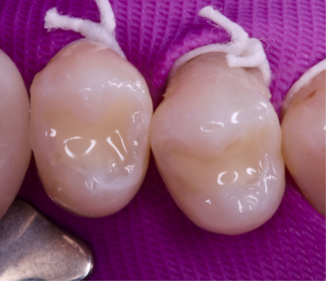 12- Cavidades preenchidas com a Charisma Bulk Flow ONE