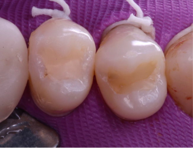 2- Isolamento do campo operatório