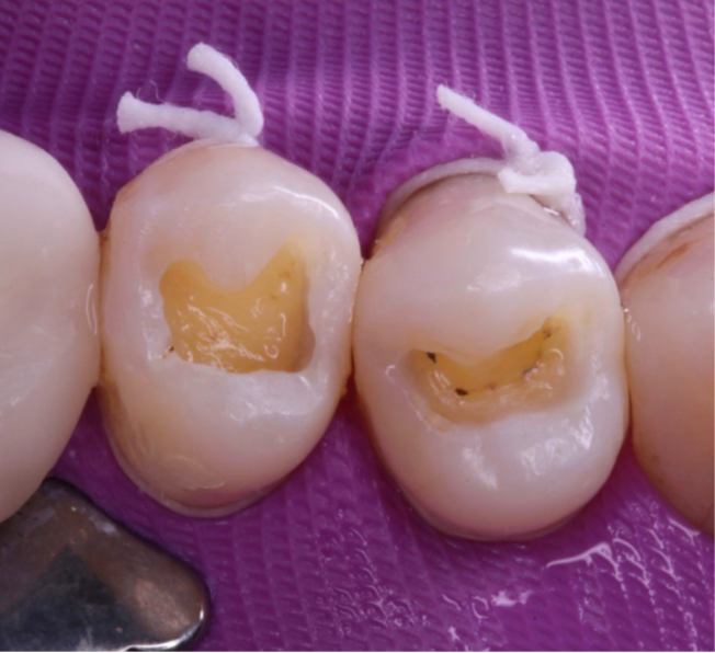 3- Restaurações antigas removidas