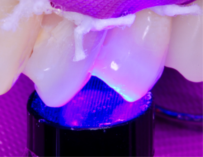 9- Fotoativação do sistema adesivo