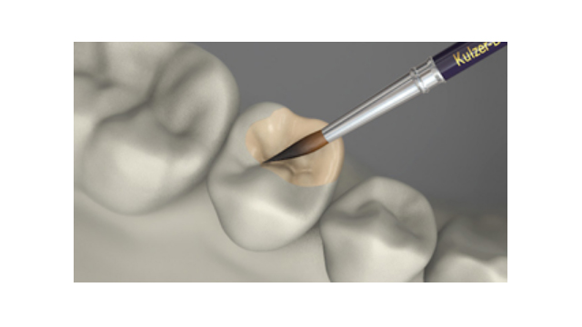 Restaurações de resina composta indireta livre de metal