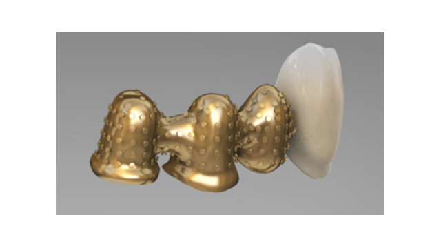 Resina indireta para metal