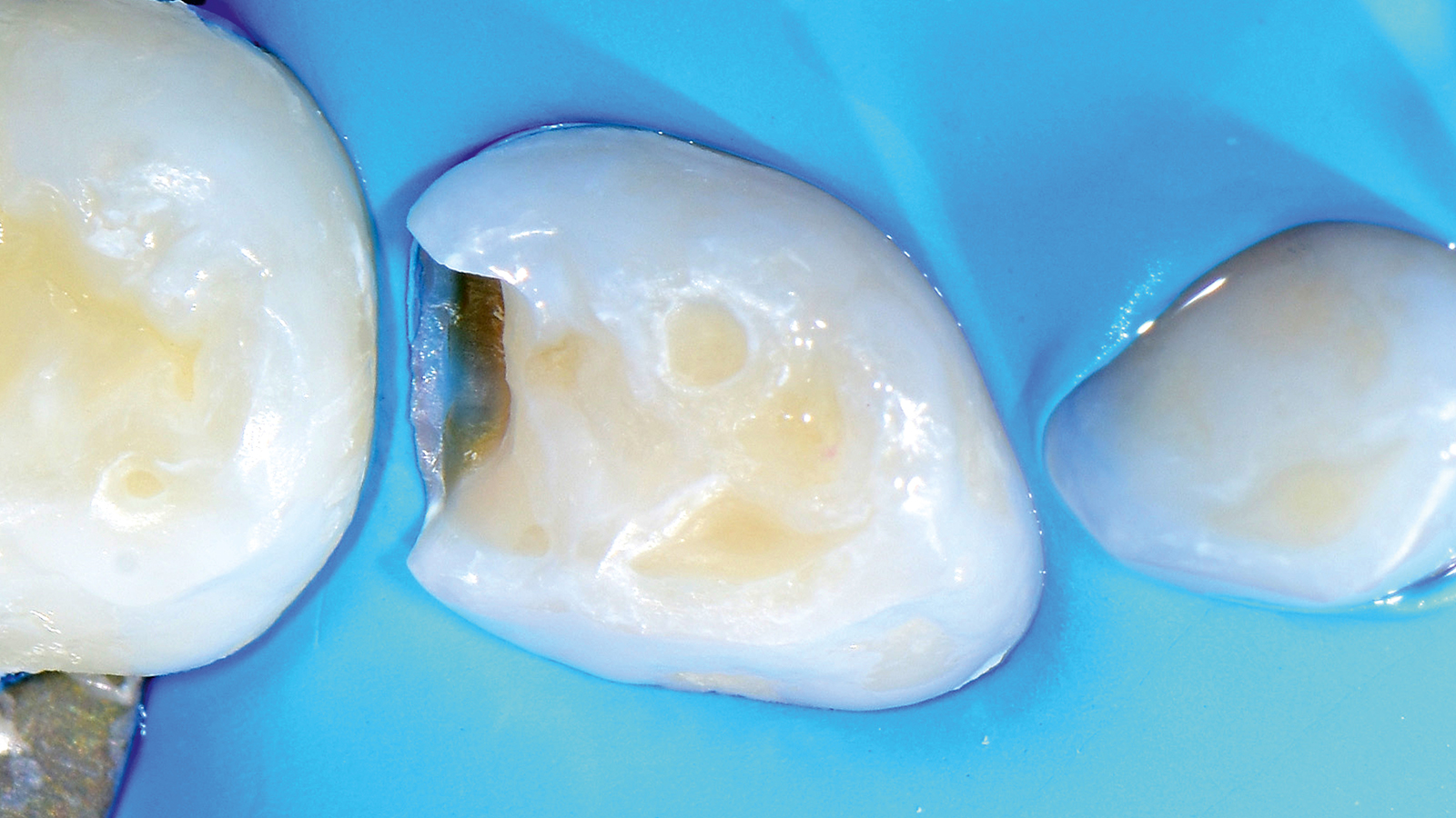 Cárie removida. Aplicação e polimerização do Gluma Bond Universal.