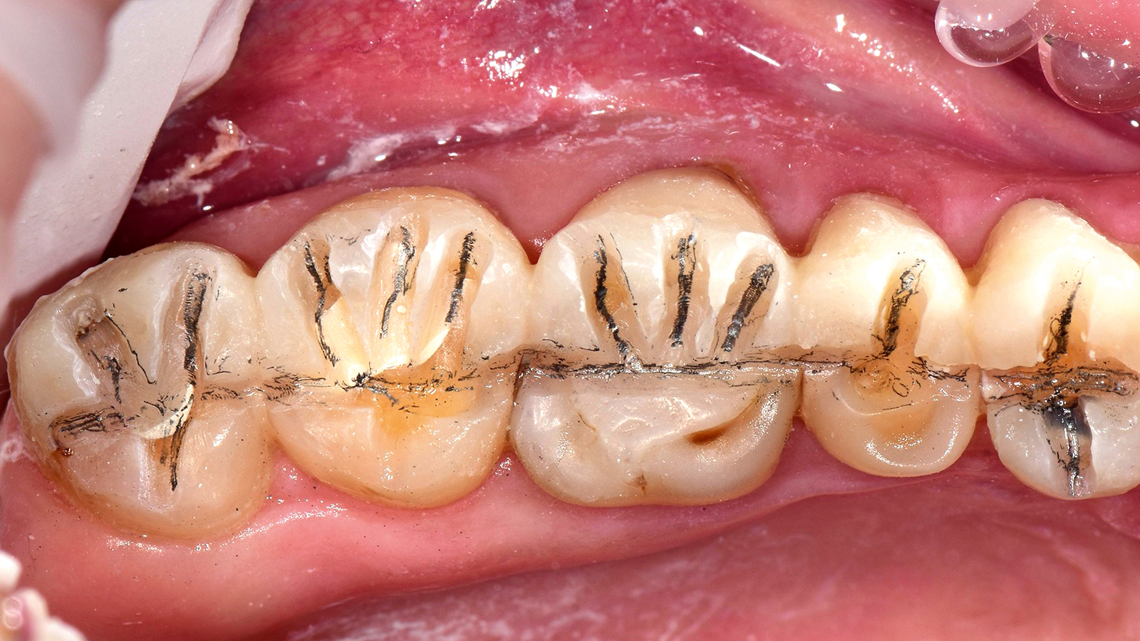 Marcação para o preparo 
