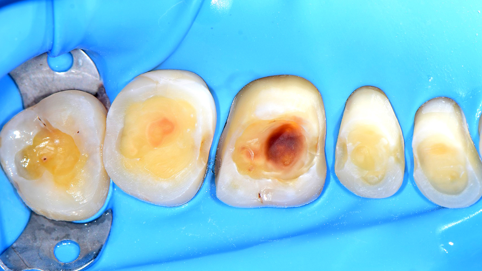 Isolamento do campo operatório com lençol de borracha e preparo da restauração.