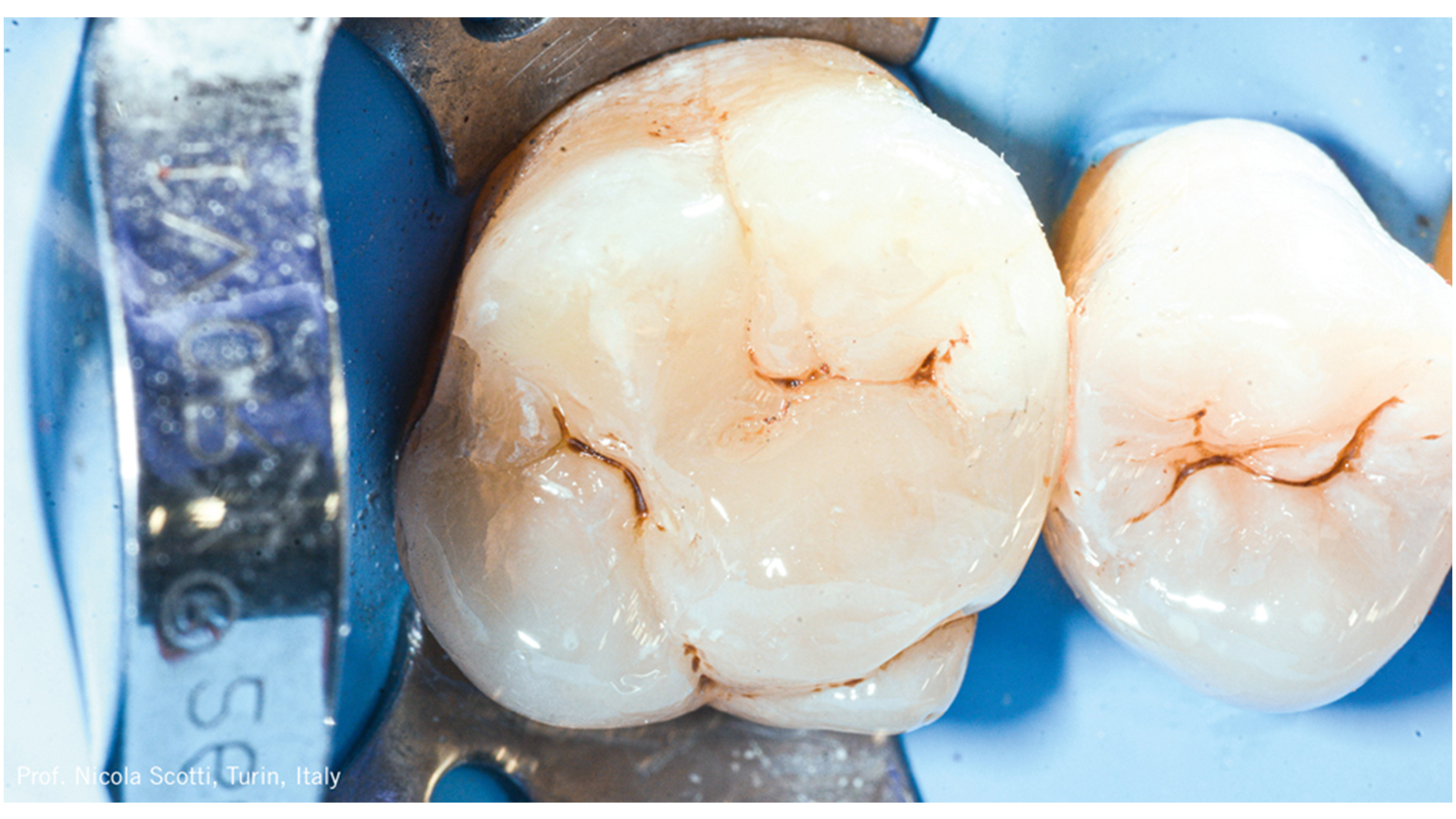 As fóssulas e fissuras foram caracterizadas com pigmento marrom. 