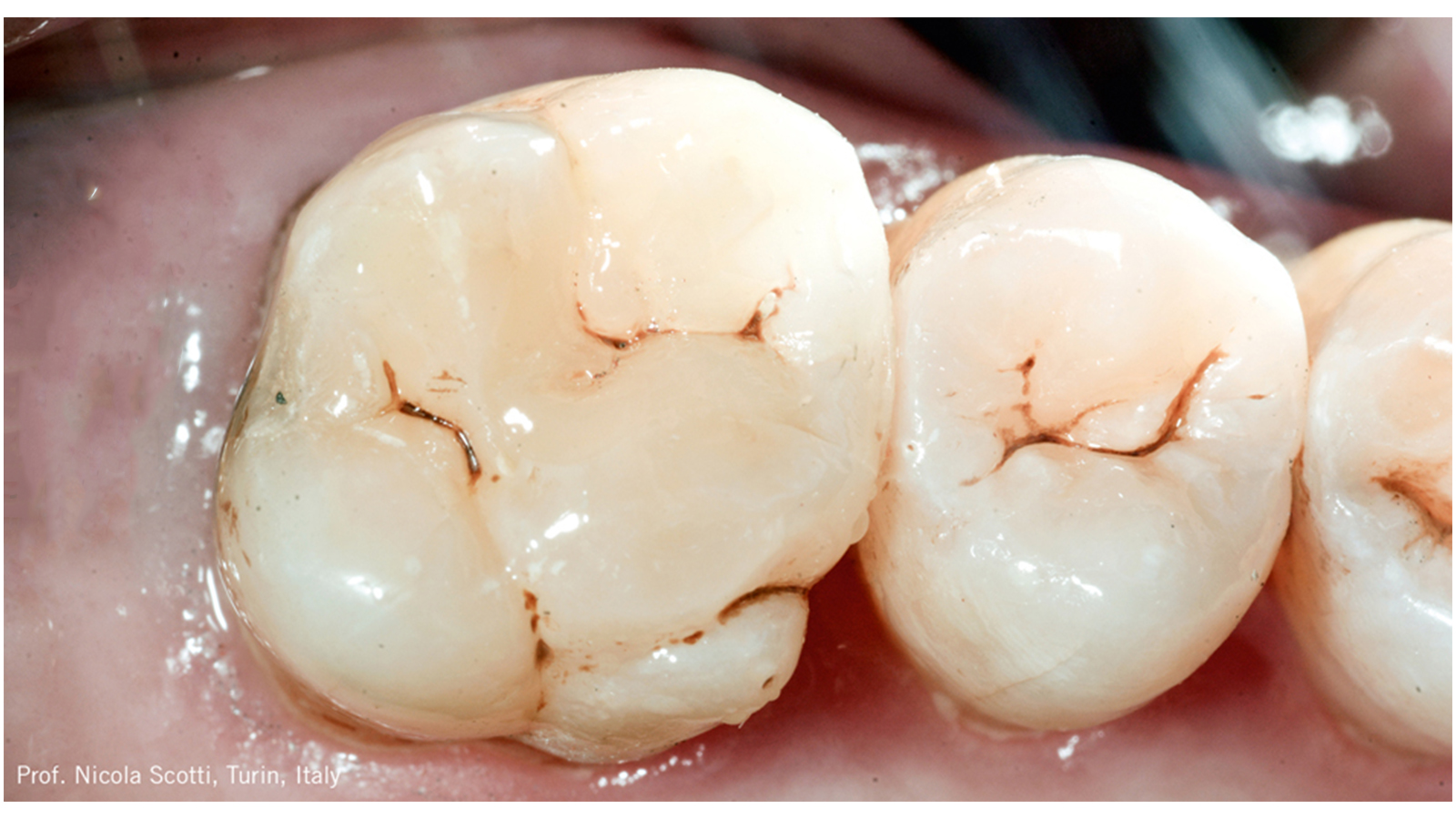 Restauração final de Charisma Diamond ONE após acabamento e polimento.