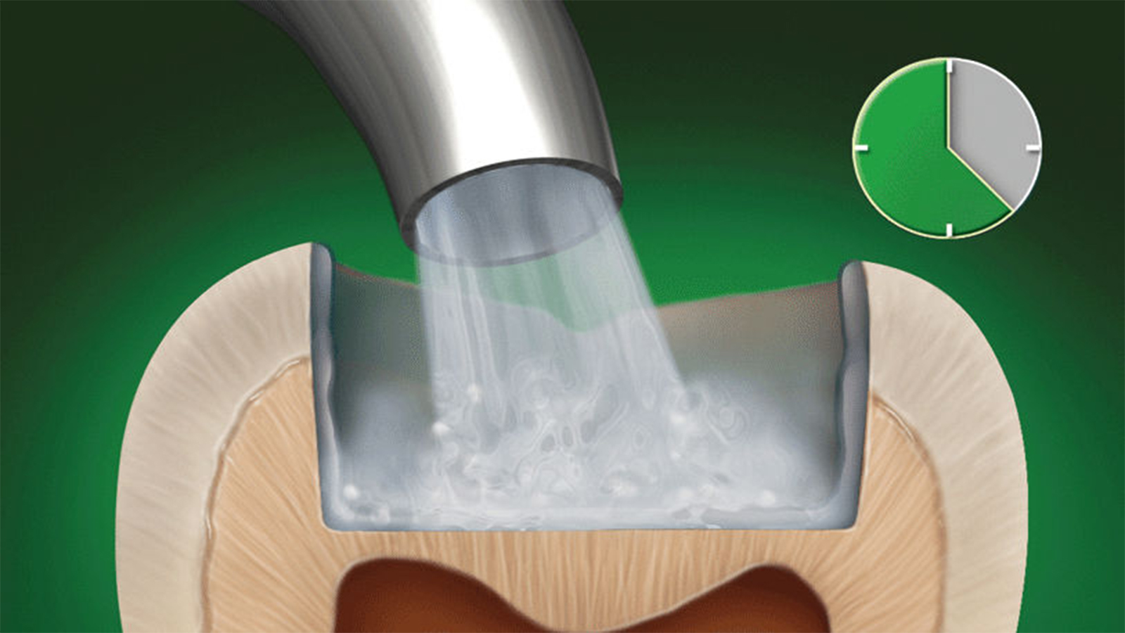 2nd step GLUMA Etch 35 Gel