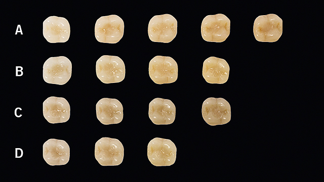 Dentes preenchidos com Charisma Diamond ONE.